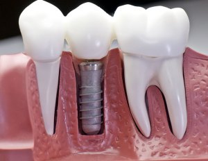 dantų implantai 
